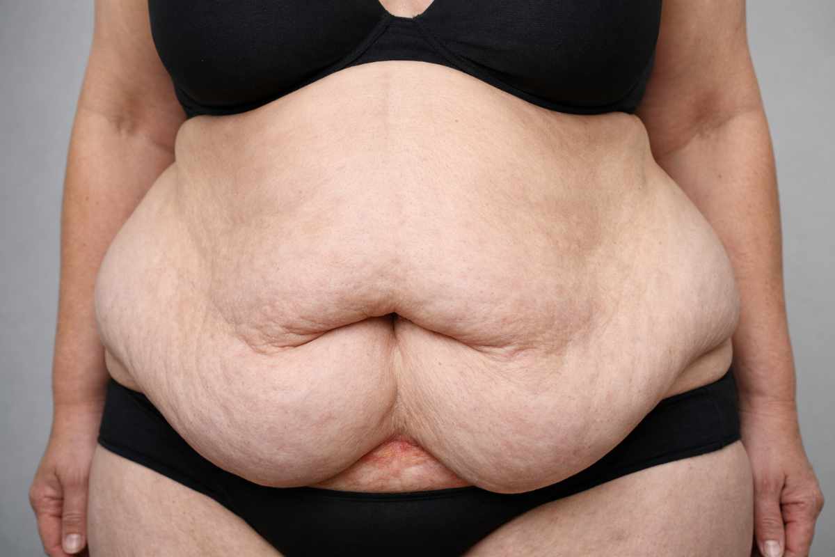 🏥 Bauchschürze – Ursachen, Probleme und wann eine Operation sinnvoll ist